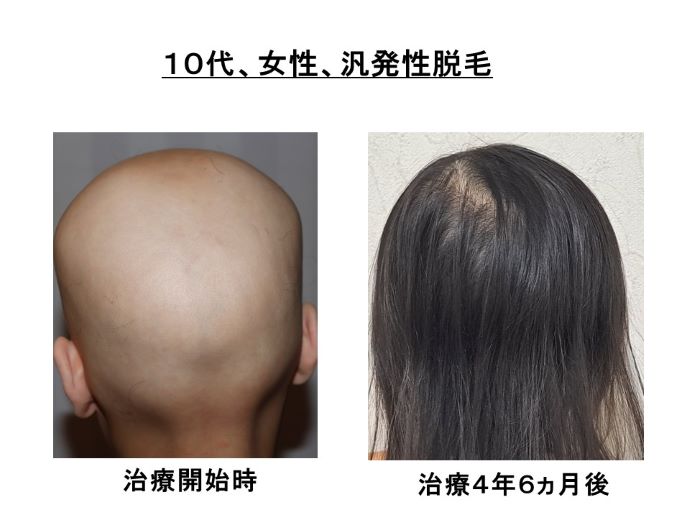 円形脱毛症　病院